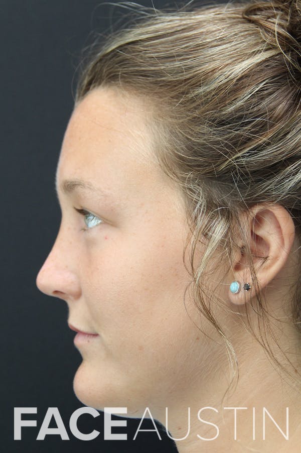 Rhinoplasty Before & After Gallery - Patient 18726393 - Image 4