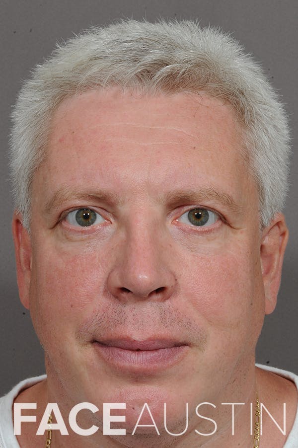 Rhinoplasty Before & After Gallery - Patient 18726391 - Image 6