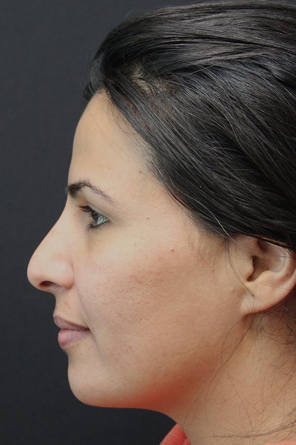 Rhinoplasty Before & After Gallery - Patient 18726394 - Image 3