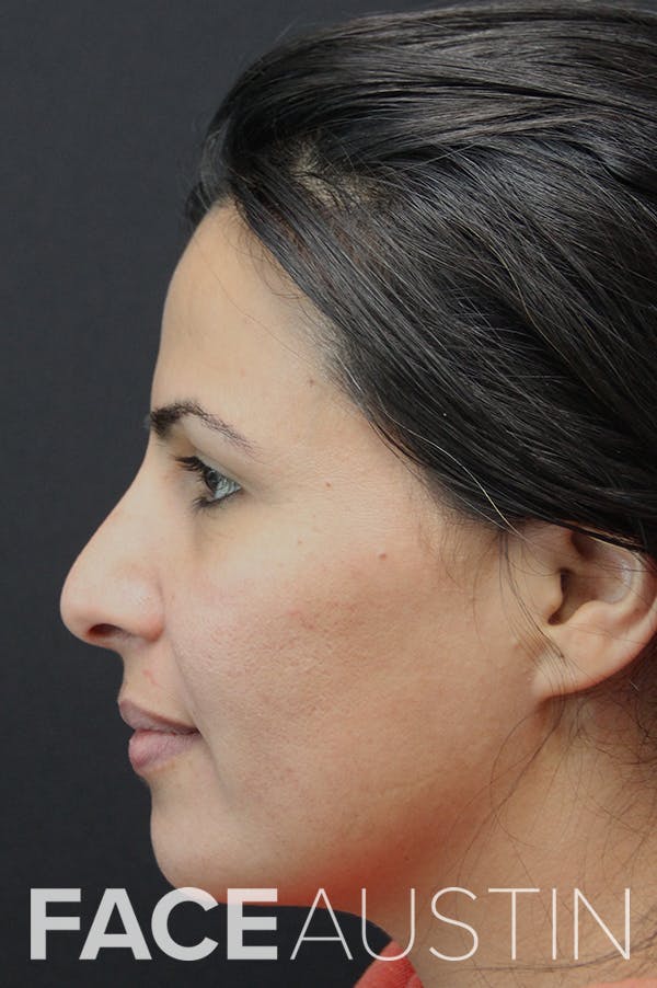 Rhinoplasty Before & After Gallery - Patient 18726394 - Image 1