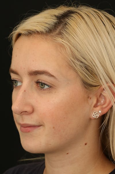 Rhinoplasty Before & After Gallery - Patient 18726392 - Image 1