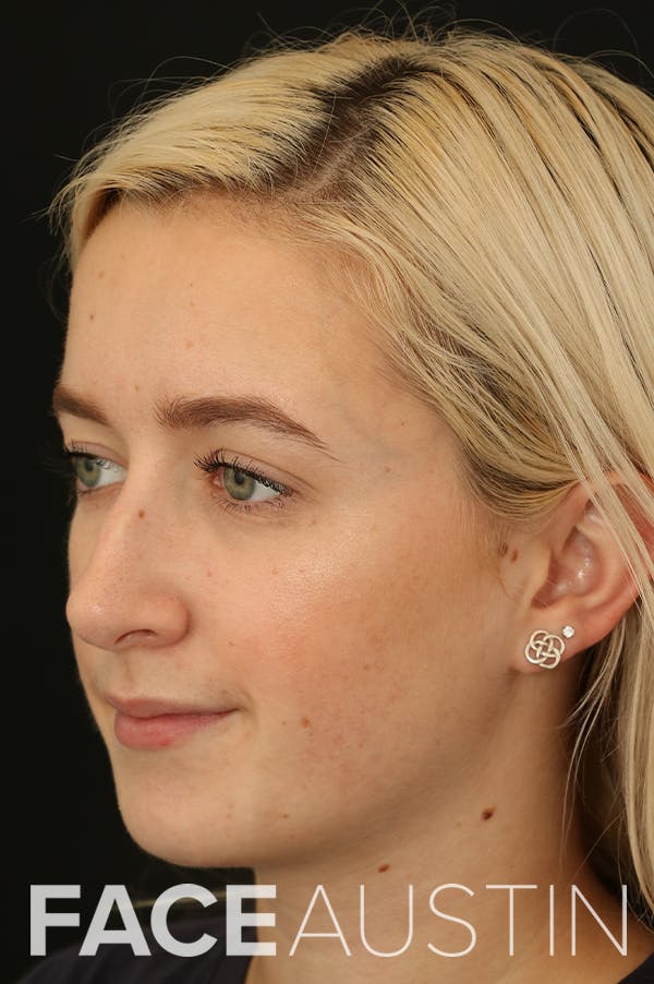 Rhinoplasty Before & After Gallery - Patient 18726392 - Image 1