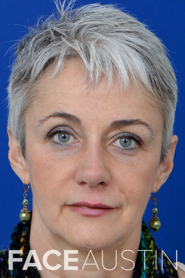 Rhinoplasty Before & After Gallery - Patient 18726390 - Image 6