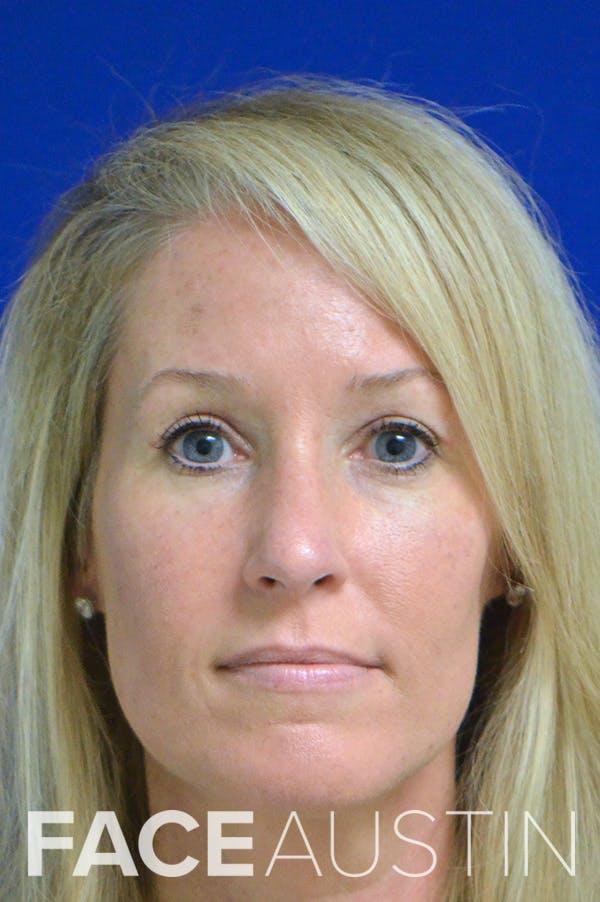 Rhinoplasty Before & After Gallery - Patient 18726389 - Image 6