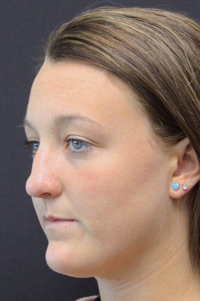 Rhinoplasty Before & After Gallery - Patient 18726393 - Image 1
