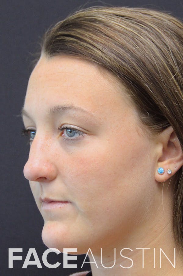 Rhinoplasty Before & After Gallery - Patient 18726393 - Image 1