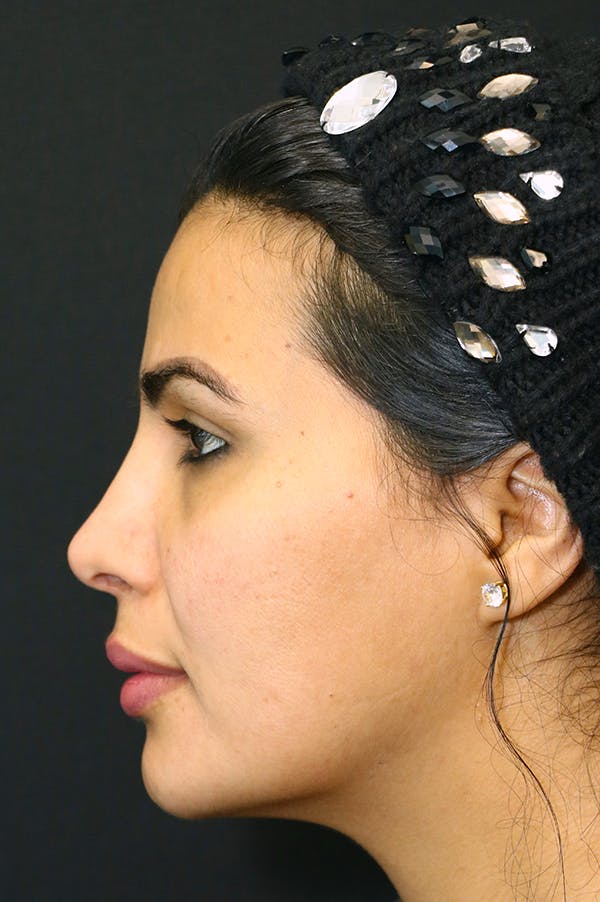 Rhinoplasty Before & After Gallery - Patient 18726394 - Image 4