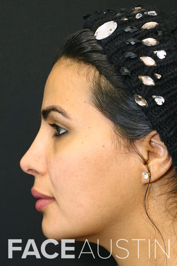Rhinoplasty Before & After Gallery - Patient 18726394 - Image 4
