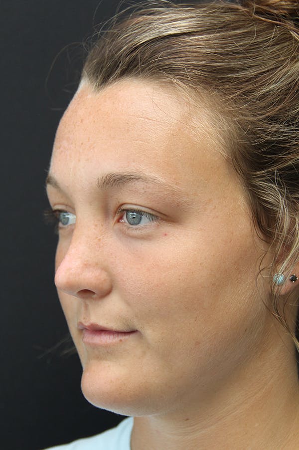 Rhinoplasty Before & After Gallery - Patient 18726393 - Image 4