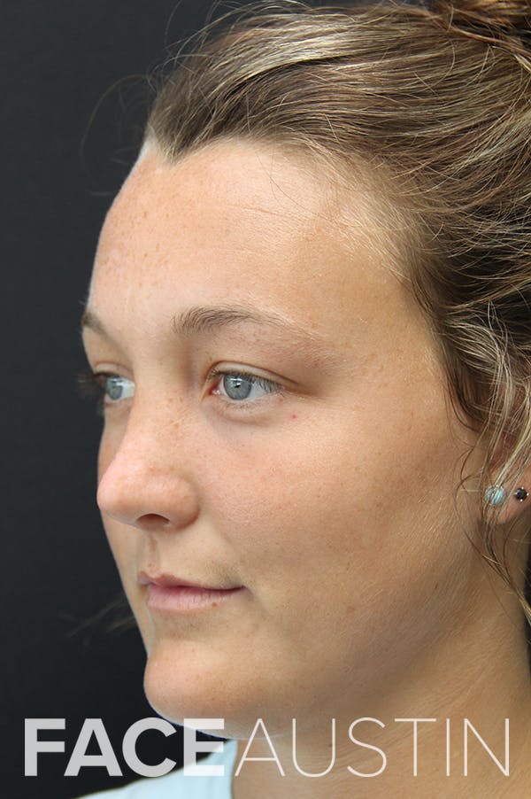 Rhinoplasty Before & After Gallery - Patient 18726393 - Image 2