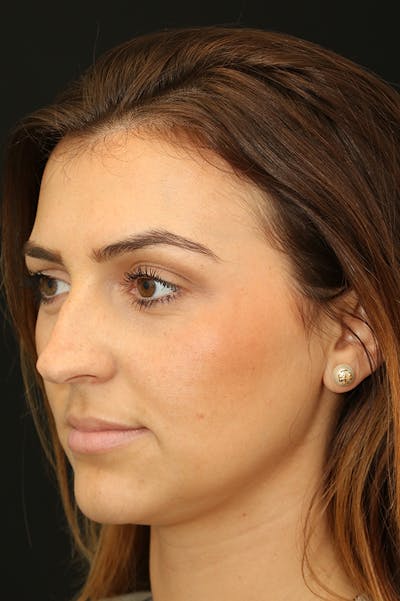 Rhinoplasty Before & After Gallery - Patient 18726395 - Image 1