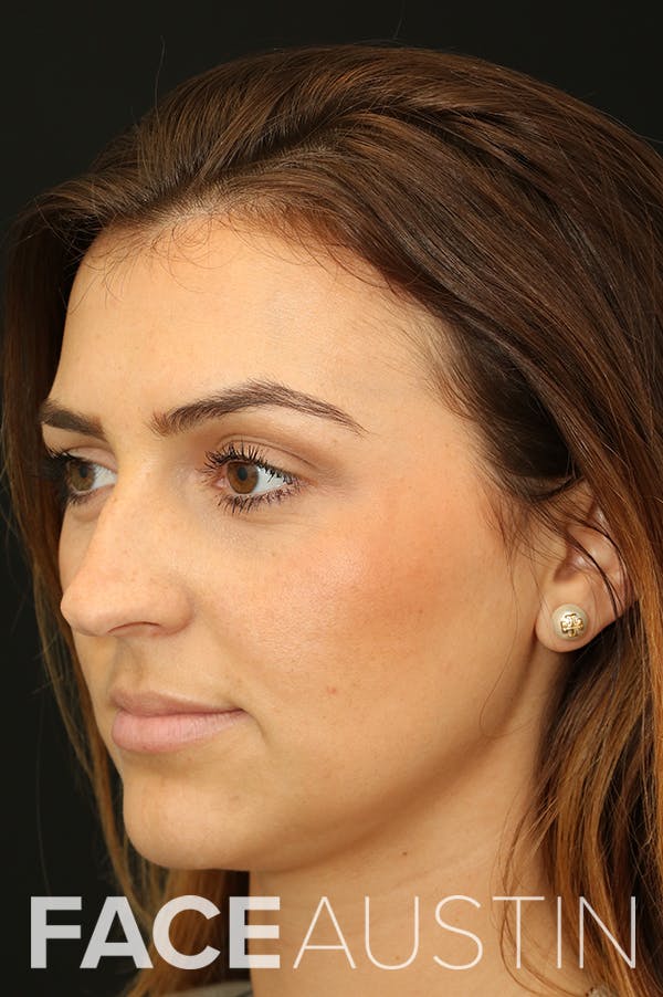 Rhinoplasty Before & After Gallery - Patient 18726395 - Image 1