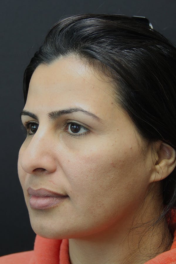 Rhinoplasty Before & After Gallery - Patient 18726394 - Image 3
