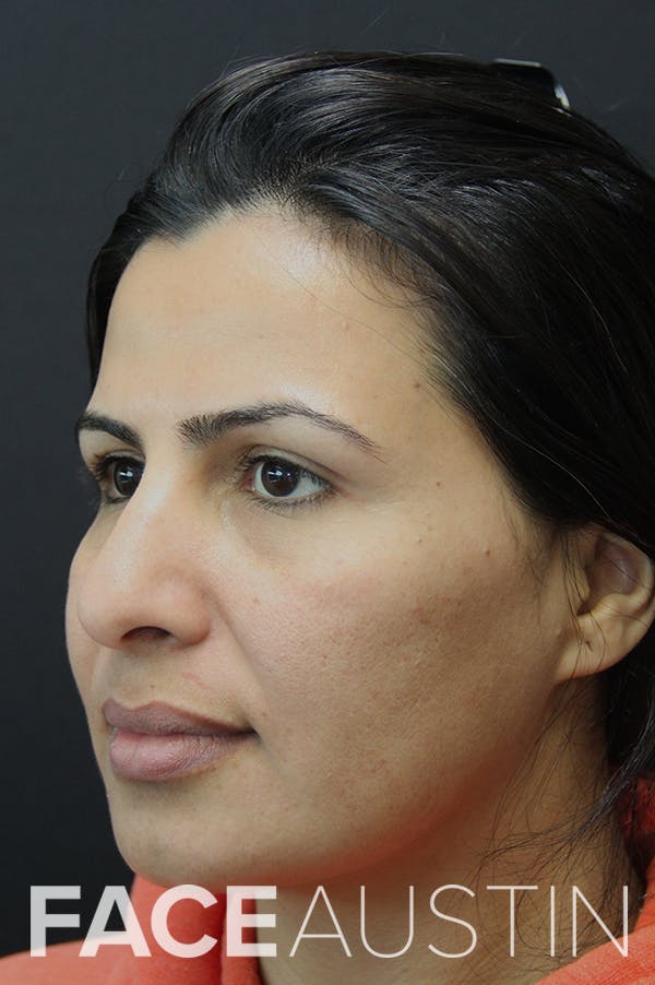 Rhinoplasty Before & After Gallery - Patient 18726394 - Image 1