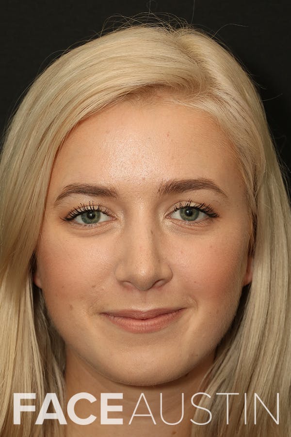 Rhinoplasty Before & After Gallery - Patient 18726392 - Image 6