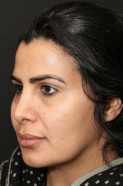 Rhinoplasty Before & After Gallery - Patient 18726394 - Image 2