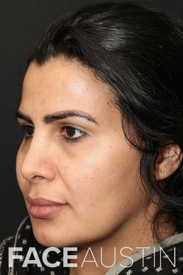 Rhinoplasty Before & After Gallery - Patient 18726394 - Image 2