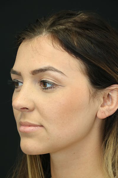 Rhinoplasty Before & After Gallery - Patient 18726395 - Image 2