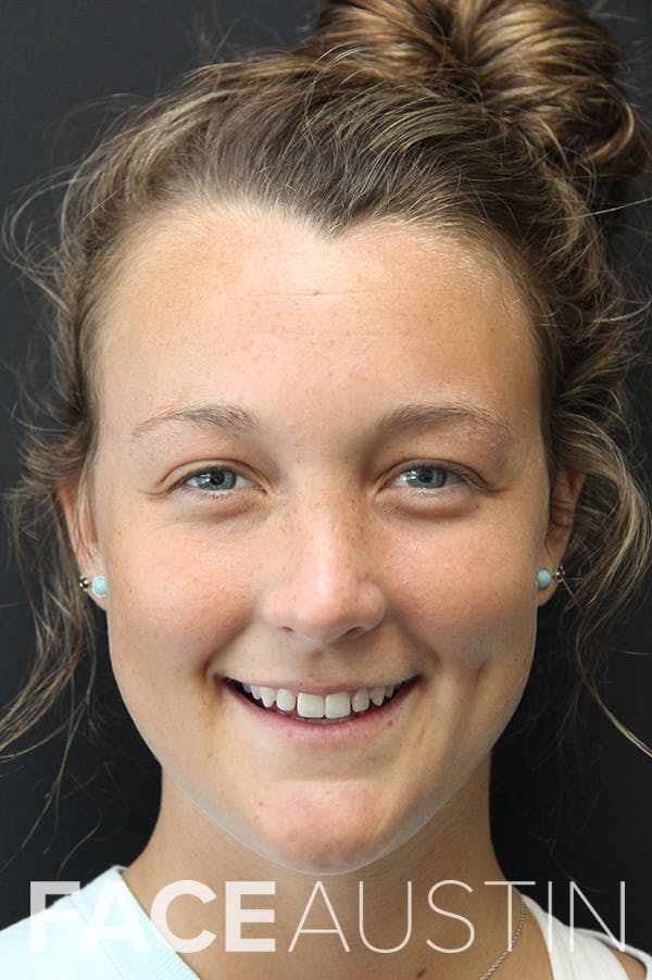 Rhinoplasty Before & After Gallery - Patient 18726393 - Image 6
