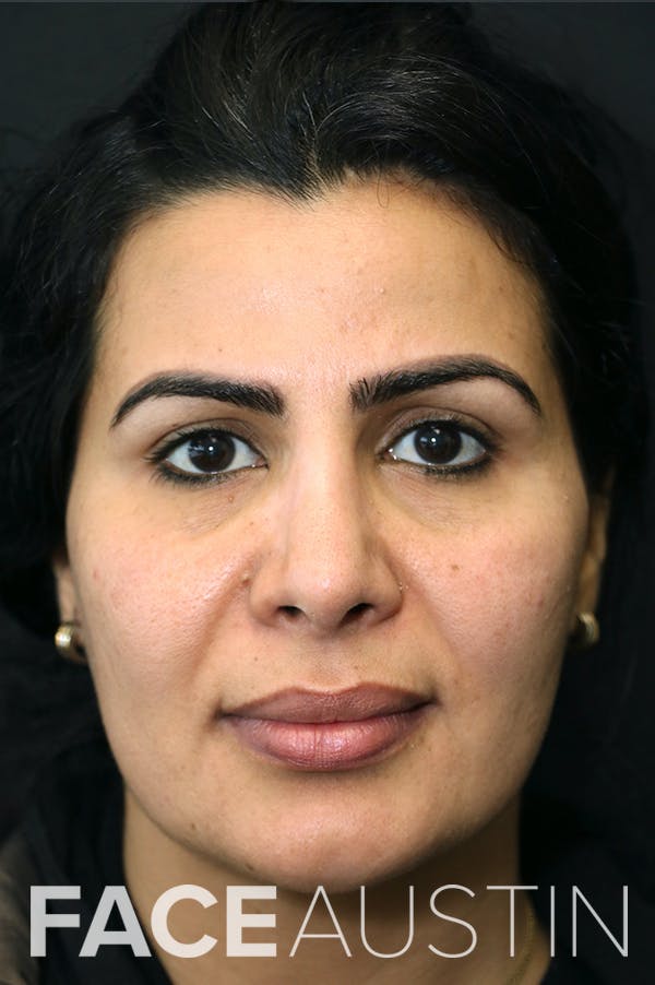 Rhinoplasty Before & After Gallery - Patient 18726394 - Image 6