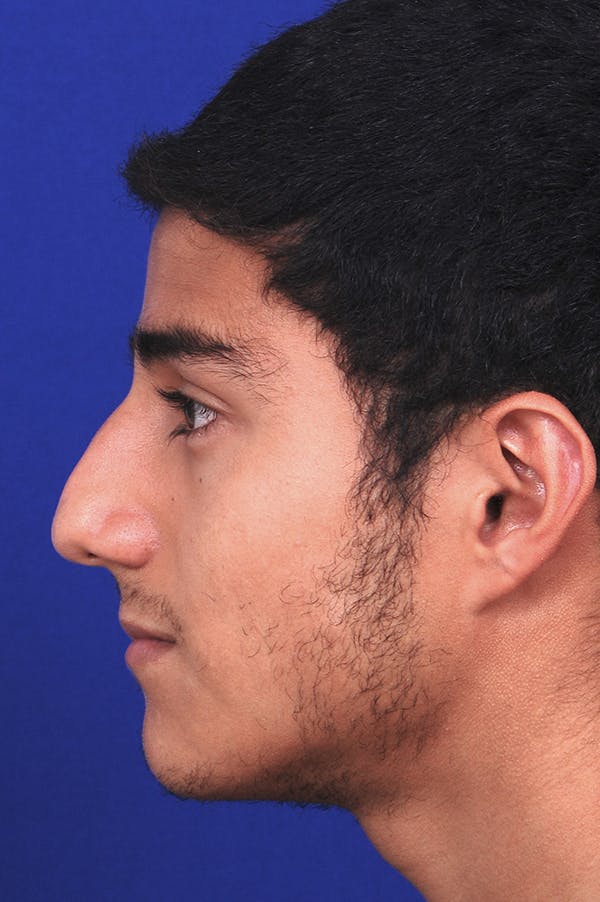 Rhinoplasty Before & After Gallery - Patient 24221120 - Image 3