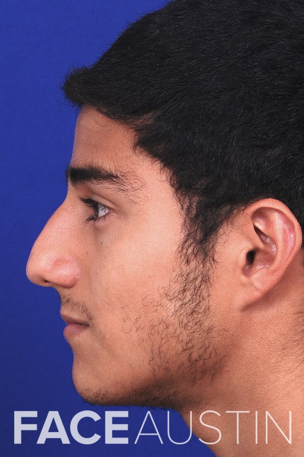Rhinoplasty Before & After Gallery - Patient 24221120 - Image 1