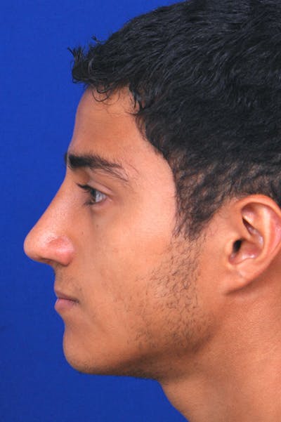 Rhinoplasty Before & After Gallery - Patient 24221120 - Image 4