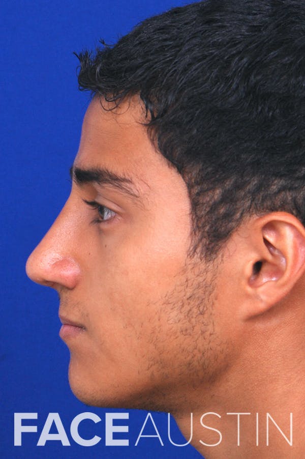 Rhinoplasty Before & After Gallery - Patient 24221120 - Image 4