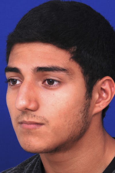 Rhinoplasty Before & After Gallery - Patient 24221120 - Image 1