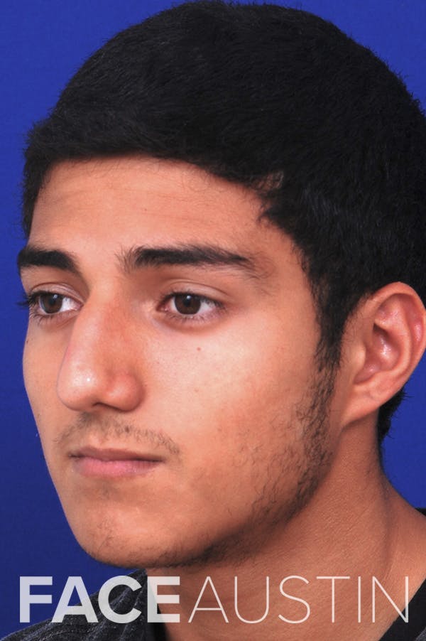 Rhinoplasty Before & After Gallery - Patient 24221120 - Image 1