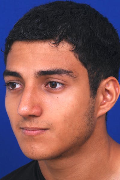 Rhinoplasty Before & After Gallery - Patient 24221120 - Image 2