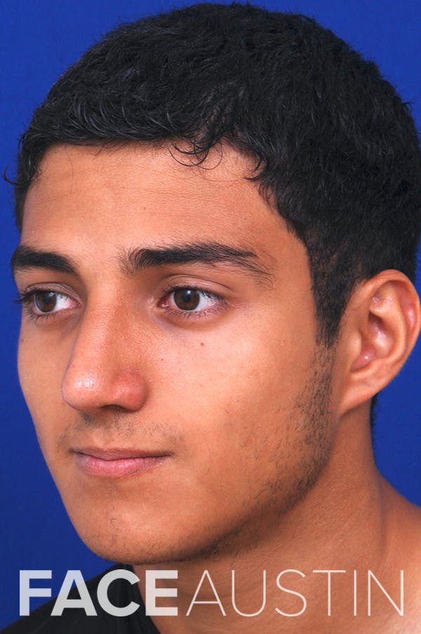 Rhinoplasty Before & After Gallery - Patient 24221120 - Image 2