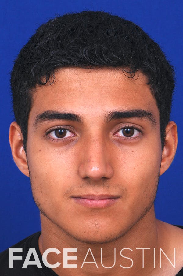 Rhinoplasty Before & After Gallery - Patient 24221120 - Image 6