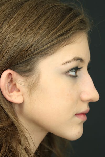 Rhinoplasty Before & After Gallery - Patient 24221121 - Image 1