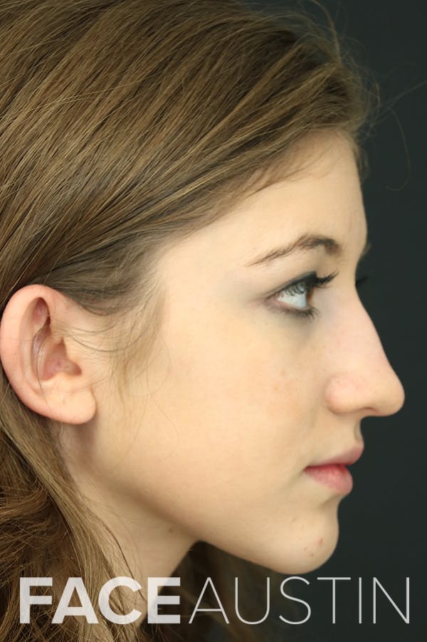 Rhinoplasty Before & After Gallery - Patient 24221121 - Image 1