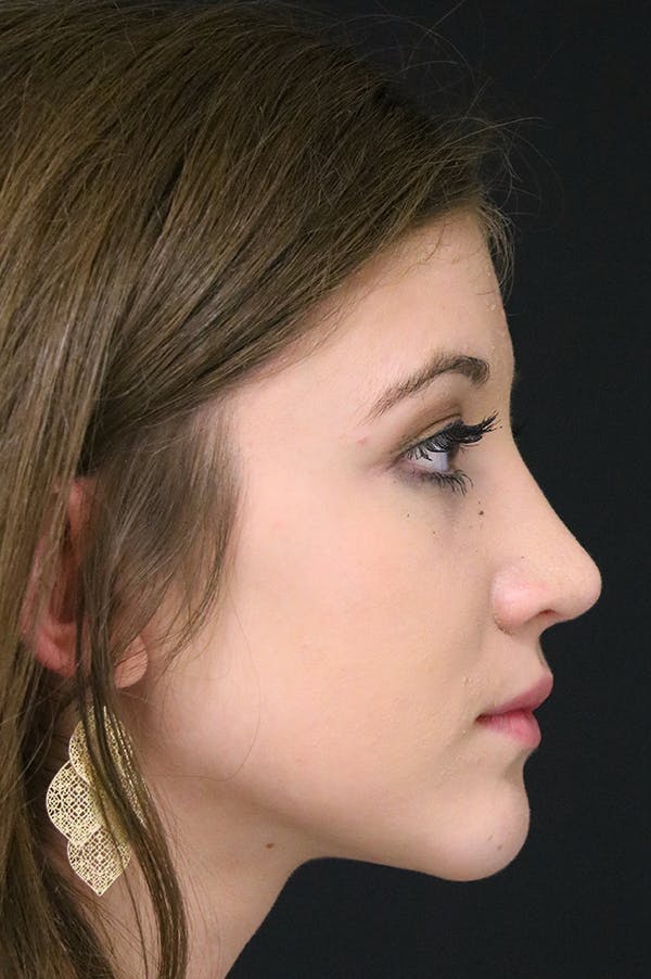 Rhinoplasty Before & After Gallery - Patient 24221121 - Image 2