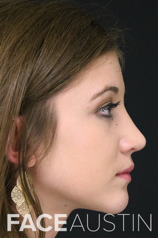 Rhinoplasty Before & After Gallery - Patient 24221121 - Image 4