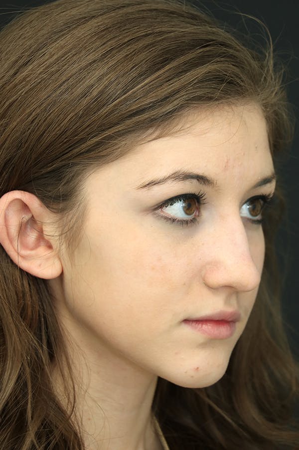 Rhinoplasty Before & After Gallery - Patient 24221121 - Image 1