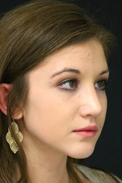 Rhinoplasty Before & After Gallery - Patient 24221121 - Image 4