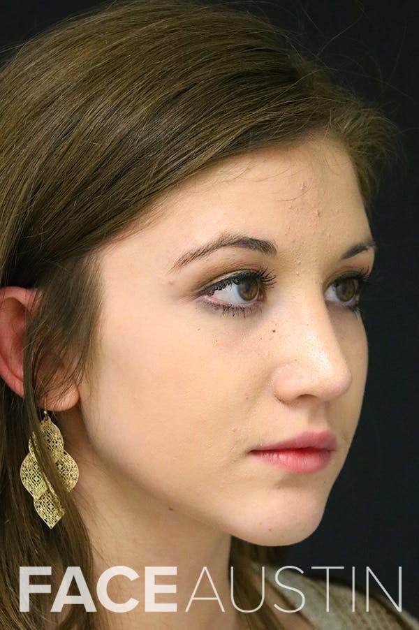 Rhinoplasty Before & After Gallery - Patient 24221121 - Image 2