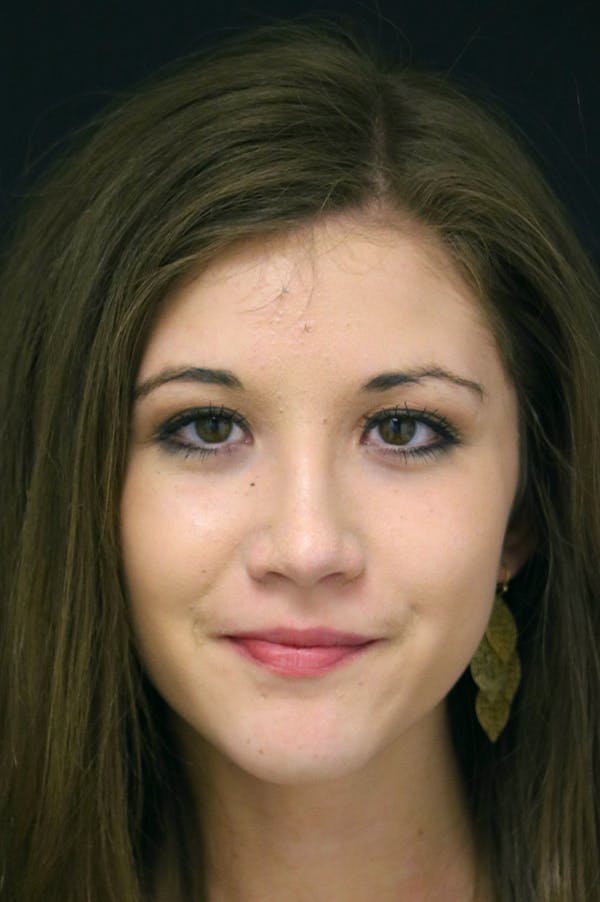 Rhinoplasty Before & After Gallery - Patient 24221121 - Image 6