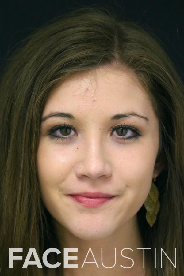 Rhinoplasty Before & After Gallery - Patient 24221121 - Image 6