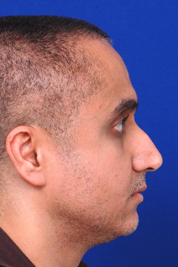 Rhinoplasty Before & After Gallery - Patient 24221122 - Image 3