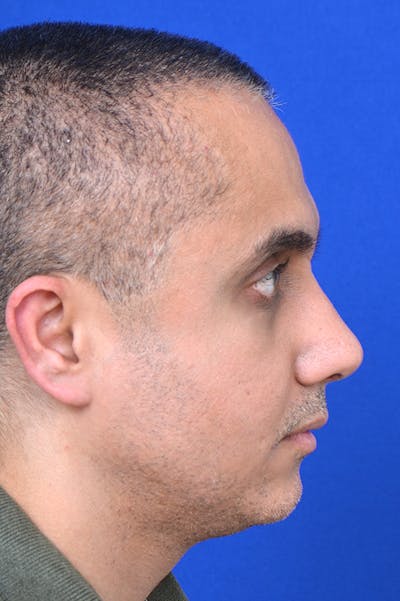 Rhinoplasty Before & After Gallery - Patient 24221122 - Image 4