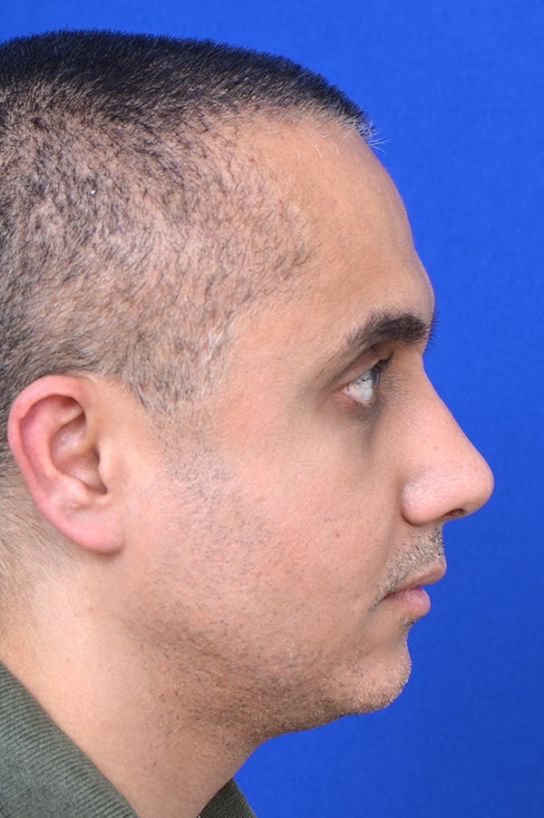 Rhinoplasty Before & After Gallery - Patient 24221122 - Image 4