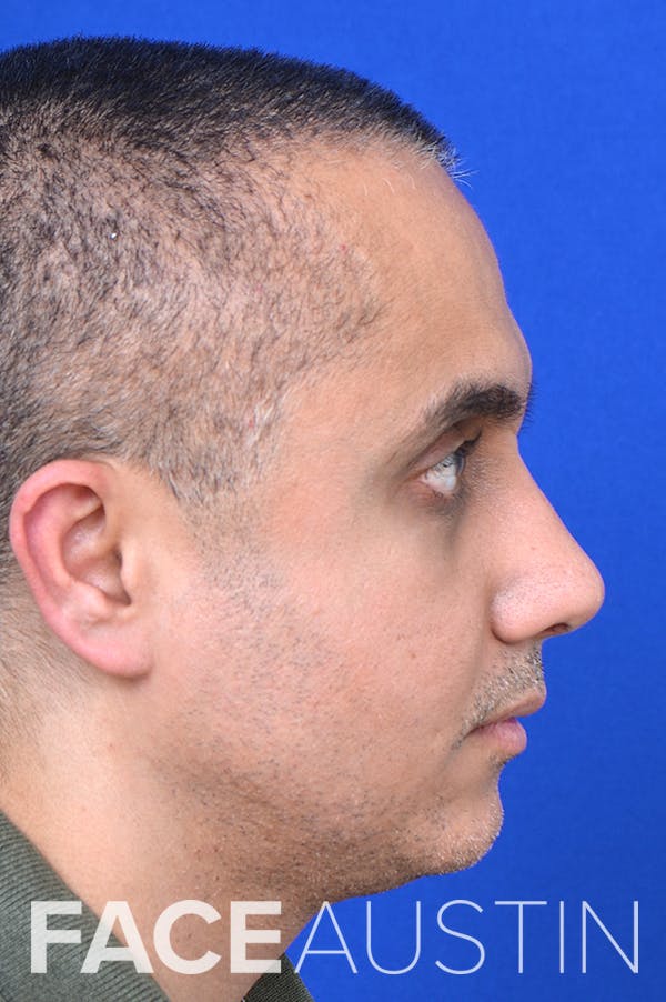 Rhinoplasty Before & After Gallery - Patient 24221122 - Image 4