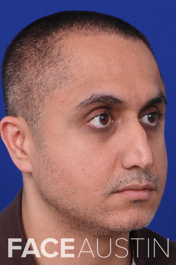 Rhinoplasty Before & After Gallery - Patient 24221122 - Image 1