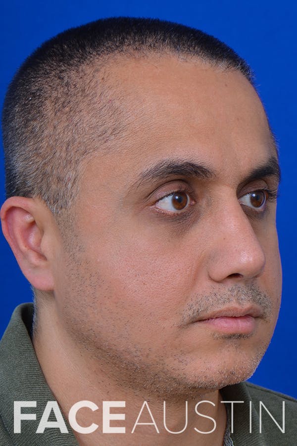 Rhinoplasty Before & After Gallery - Patient 24221122 - Image 2