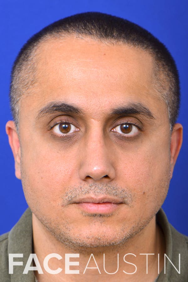Rhinoplasty Before & After Gallery - Patient 24221122 - Image 6