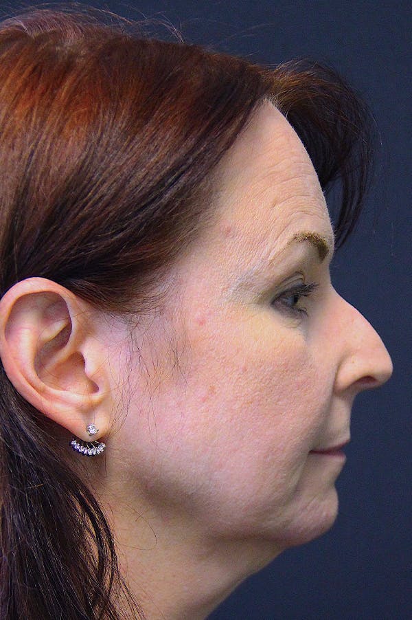 Rhinoplasty Before & After Gallery - Patient 24221123 - Image 3